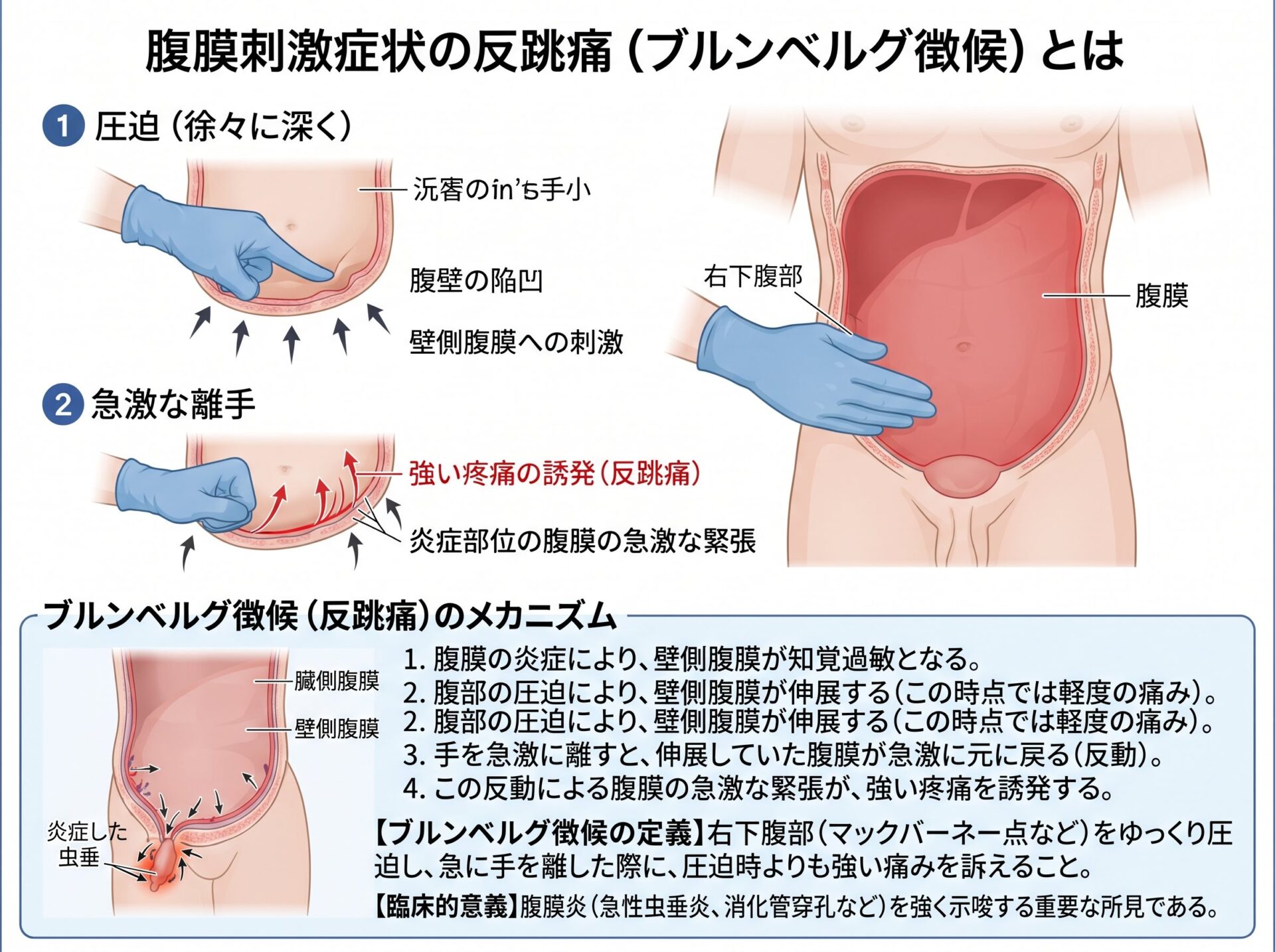 腹膜刺激症状の反跳痛(ブルンベルグ徴候)とは