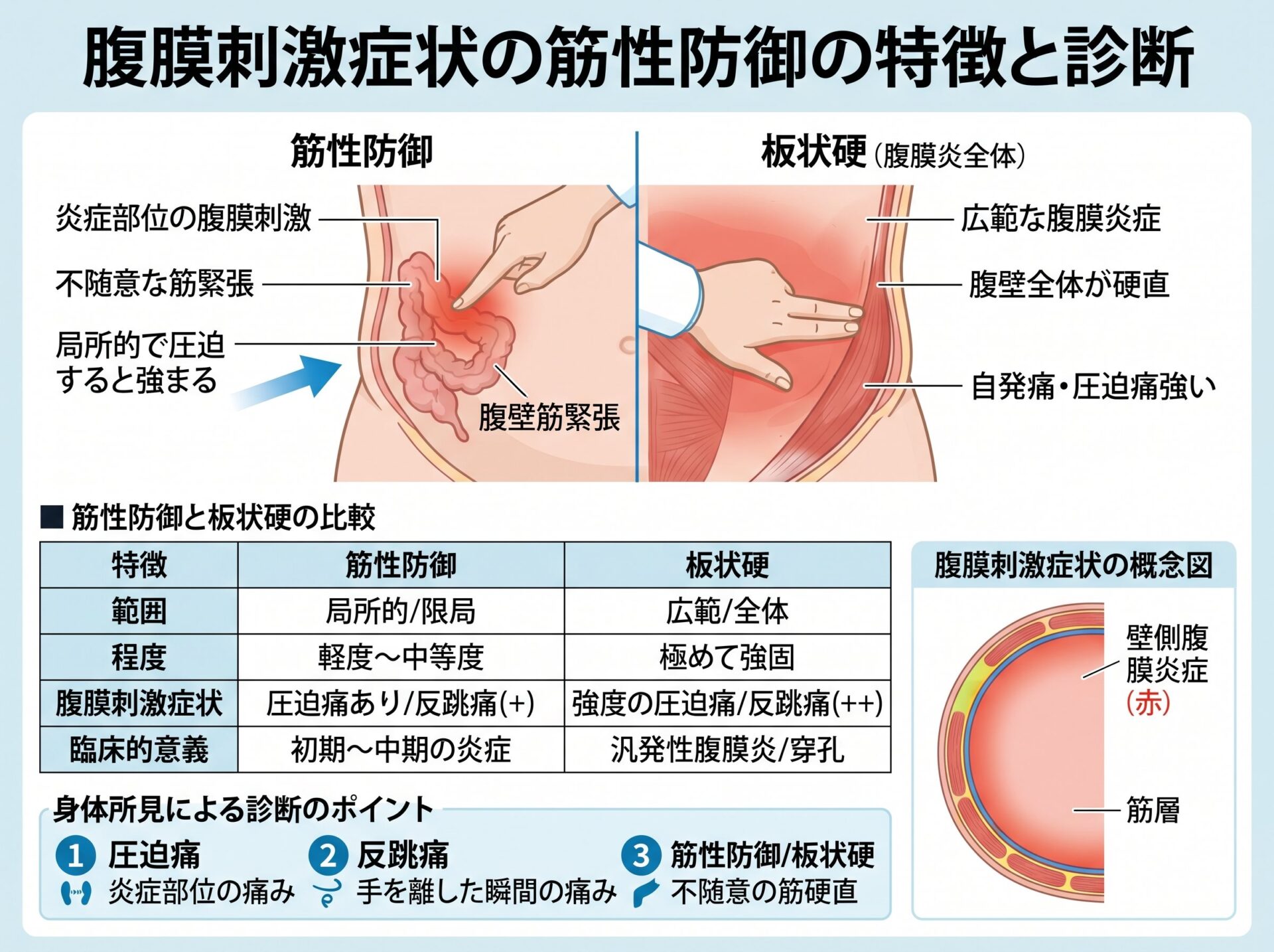 腹膜刺激症状の筋性防御の特徴と診断