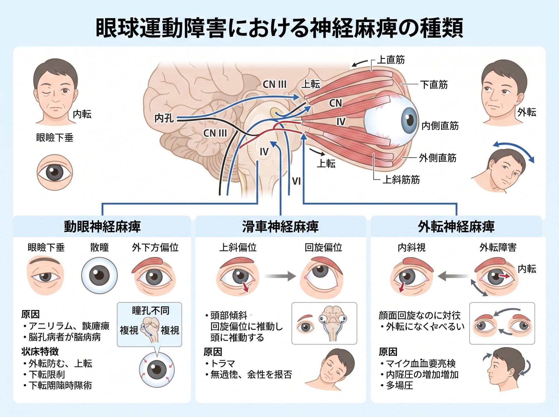 眼球運動障害における神経麻痺の種類