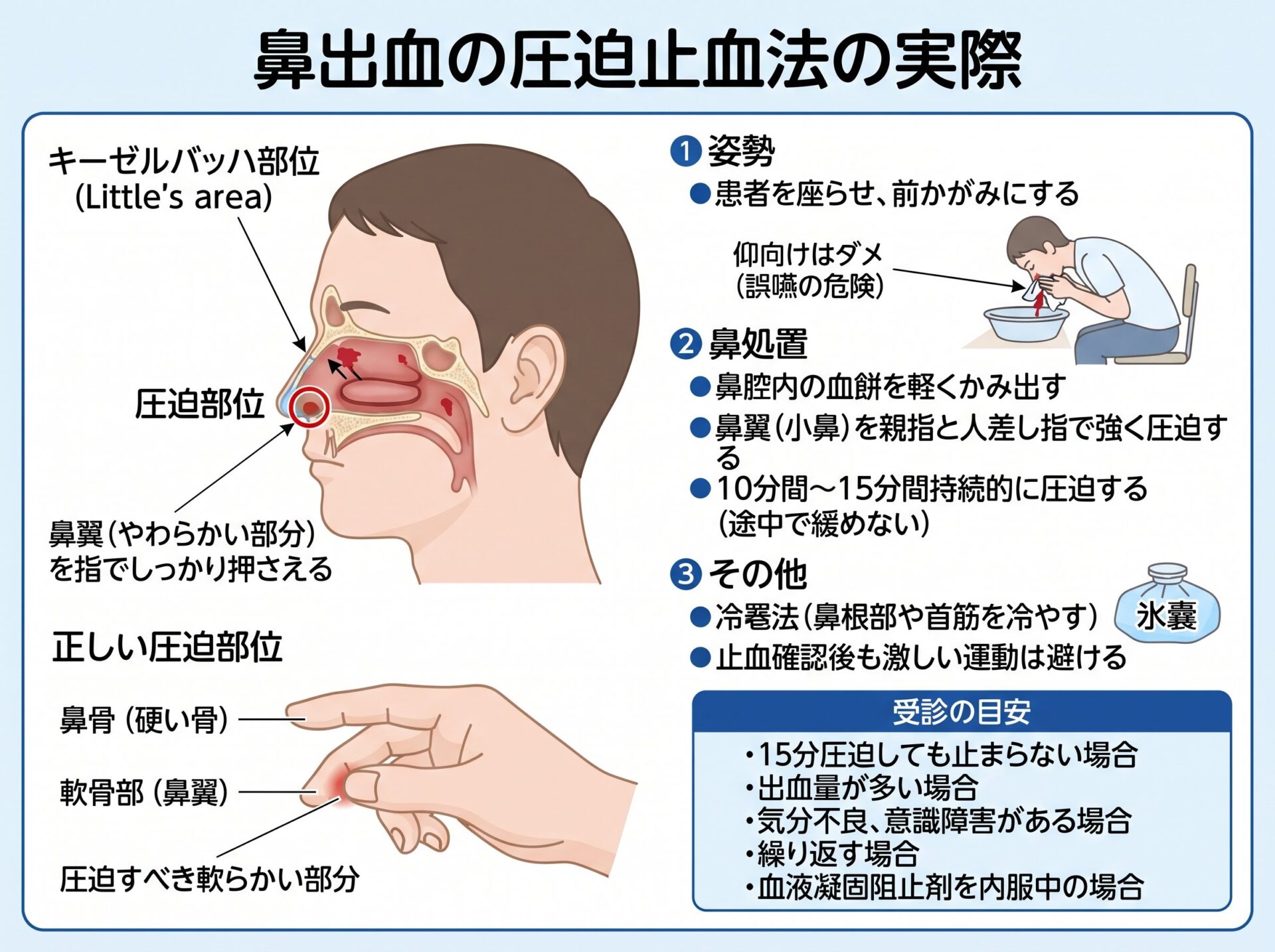 鼻出血の圧迫止血法の実際