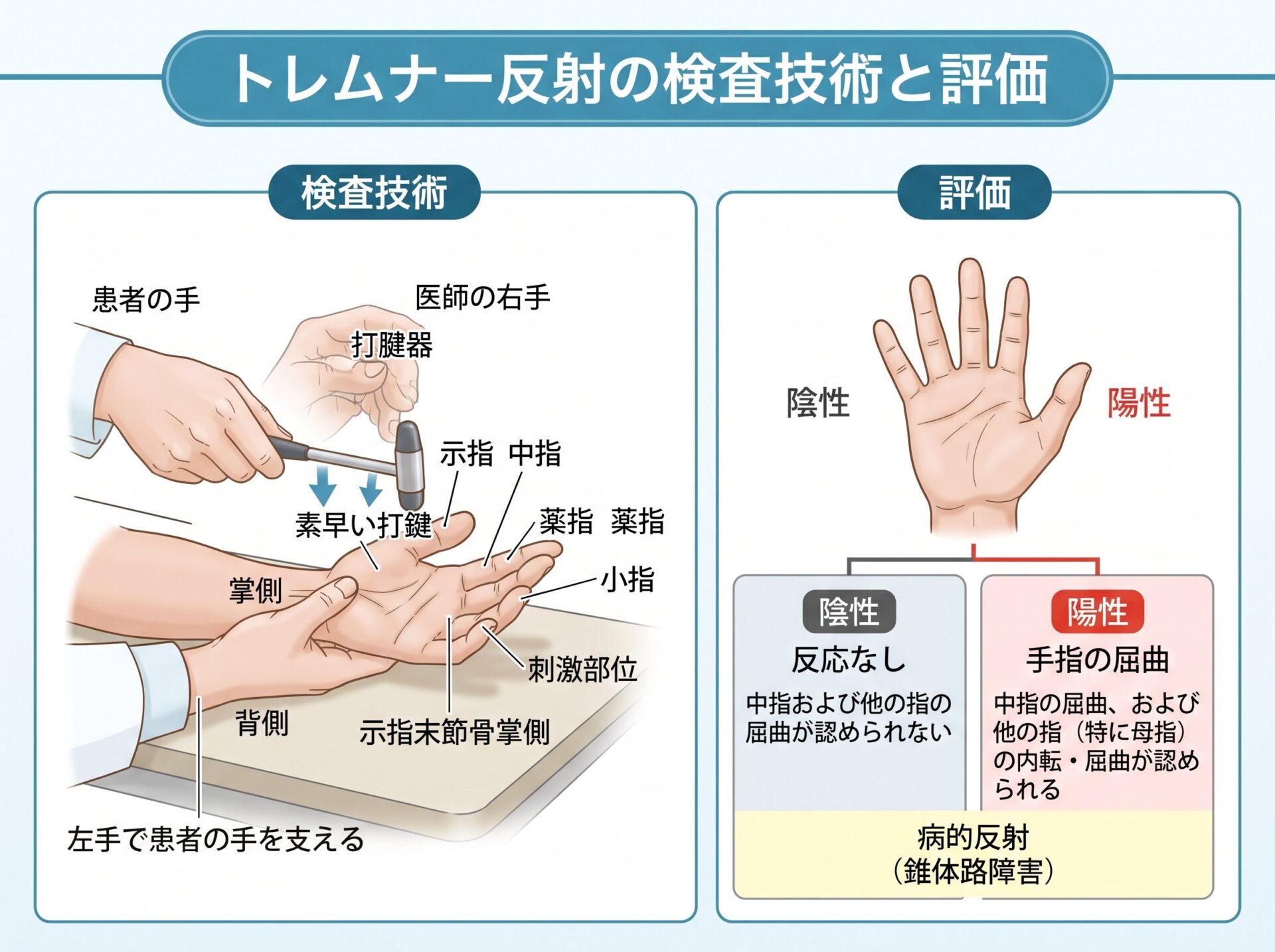 トレムナー反射の検査技術と評価