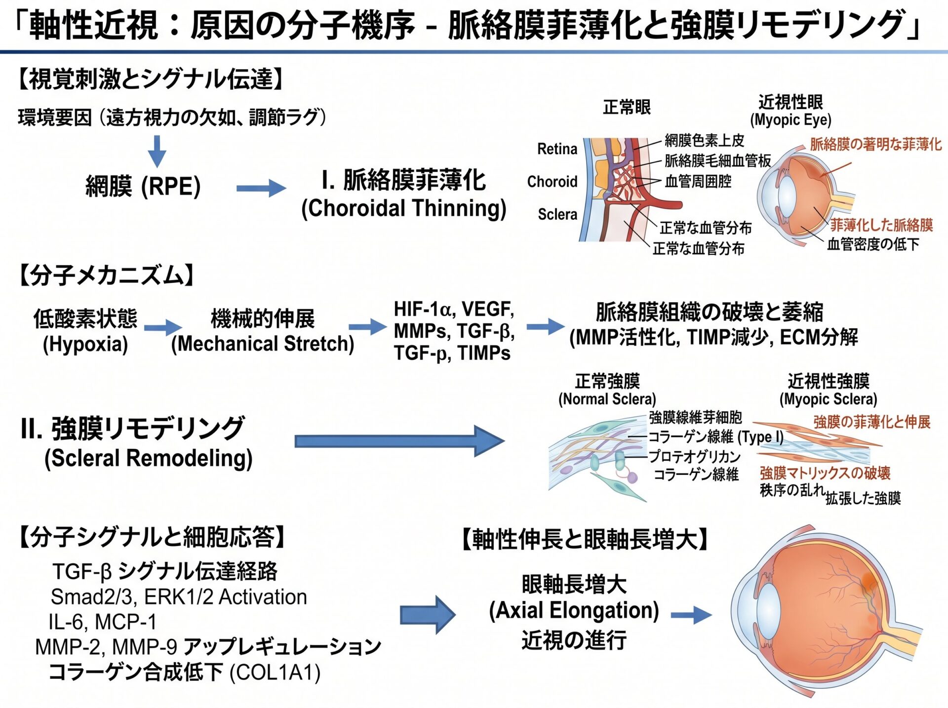 軸性近視 原因の分子機序：脈絡膜菲薄化と強膜リモデリング