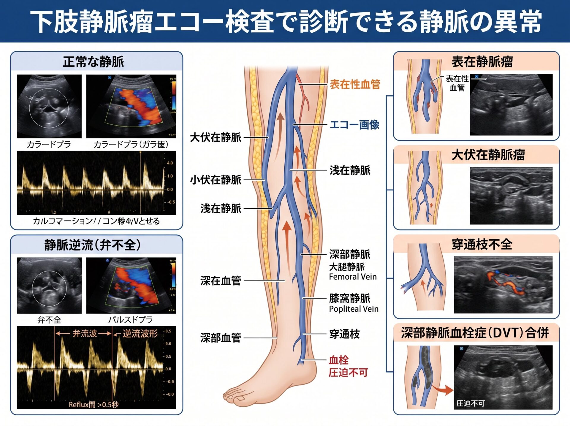 下肢静脈瘤エコー検査で診断できる静脈の異常