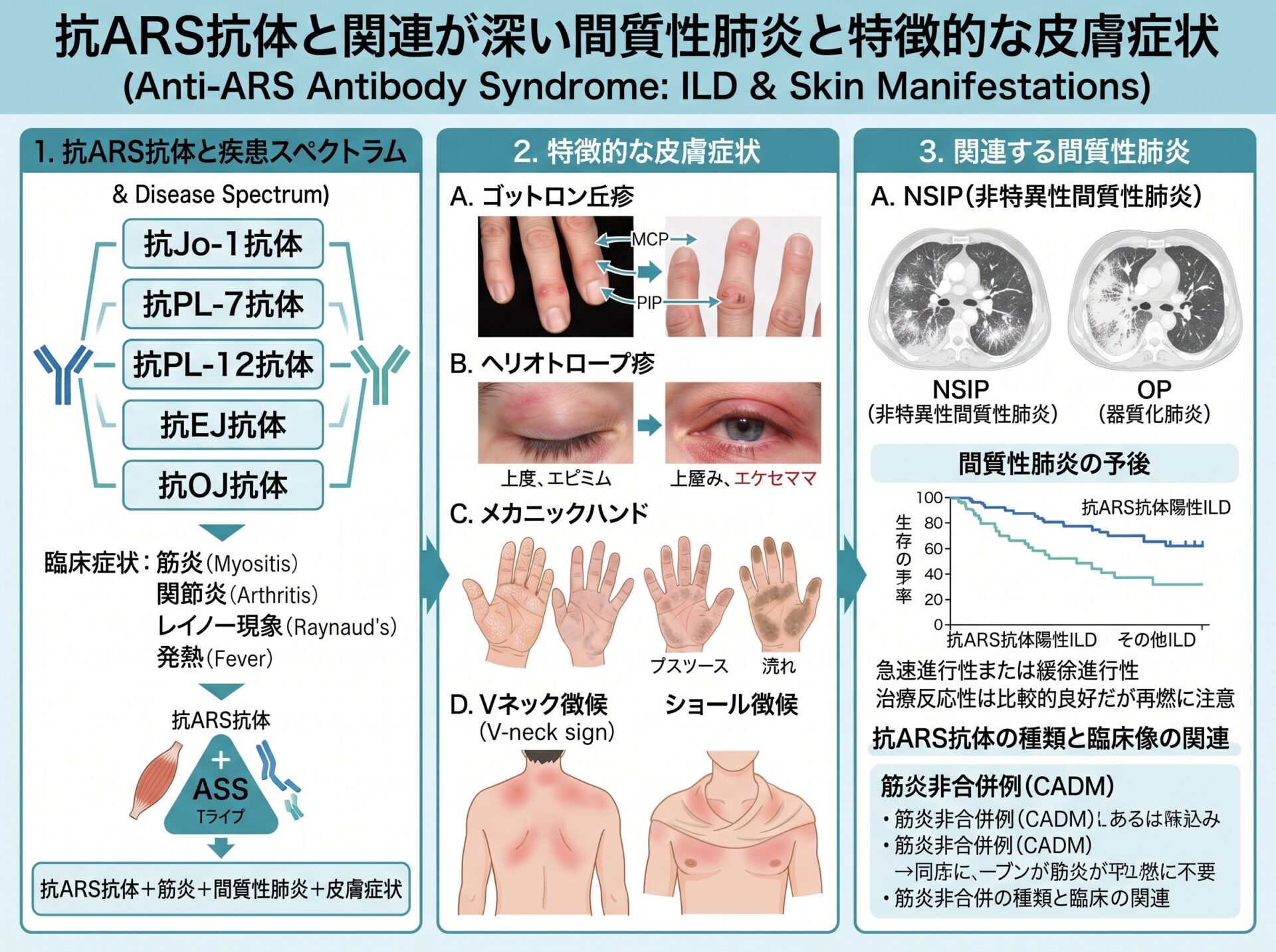 抗ARS抗体と関連が深い間質性肺炎と特徴的な皮膚症状