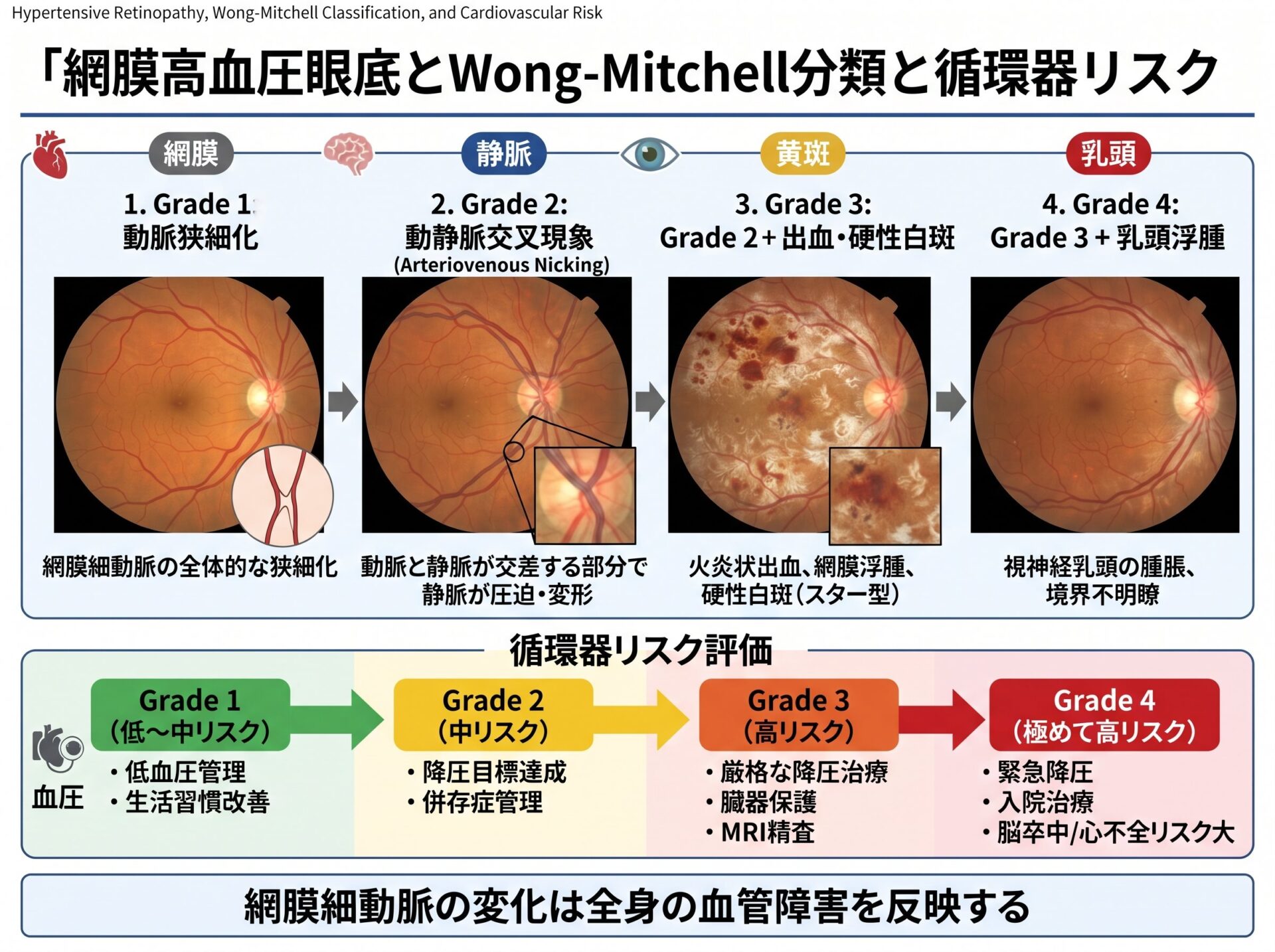 網膜高血圧眼底とWong-Mitchell分類と循環器リスク