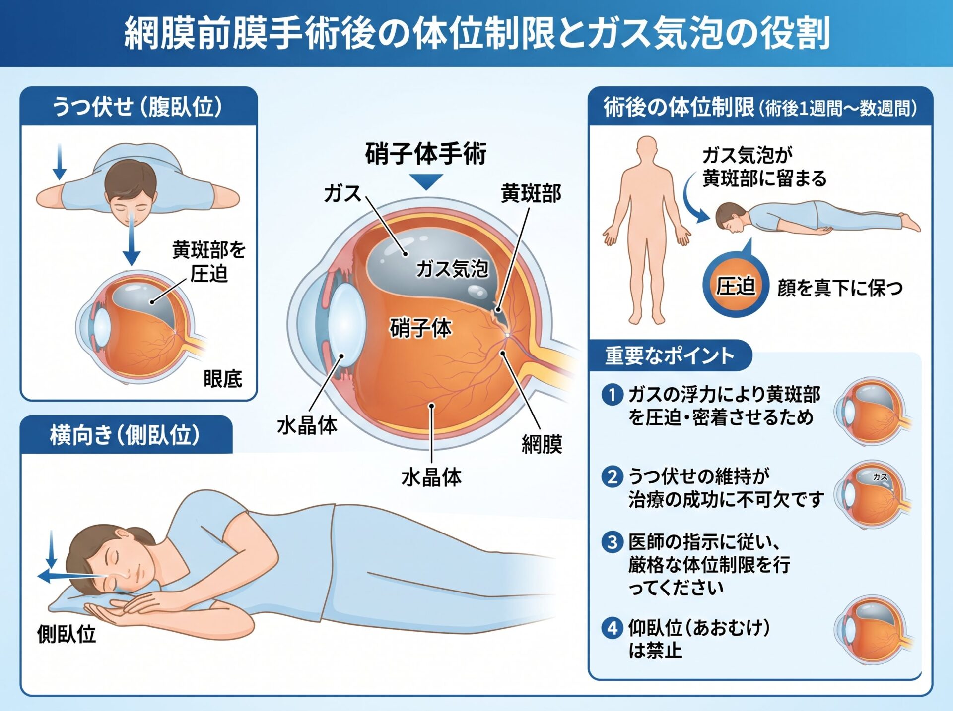 網膜前膜の体位制限とガス