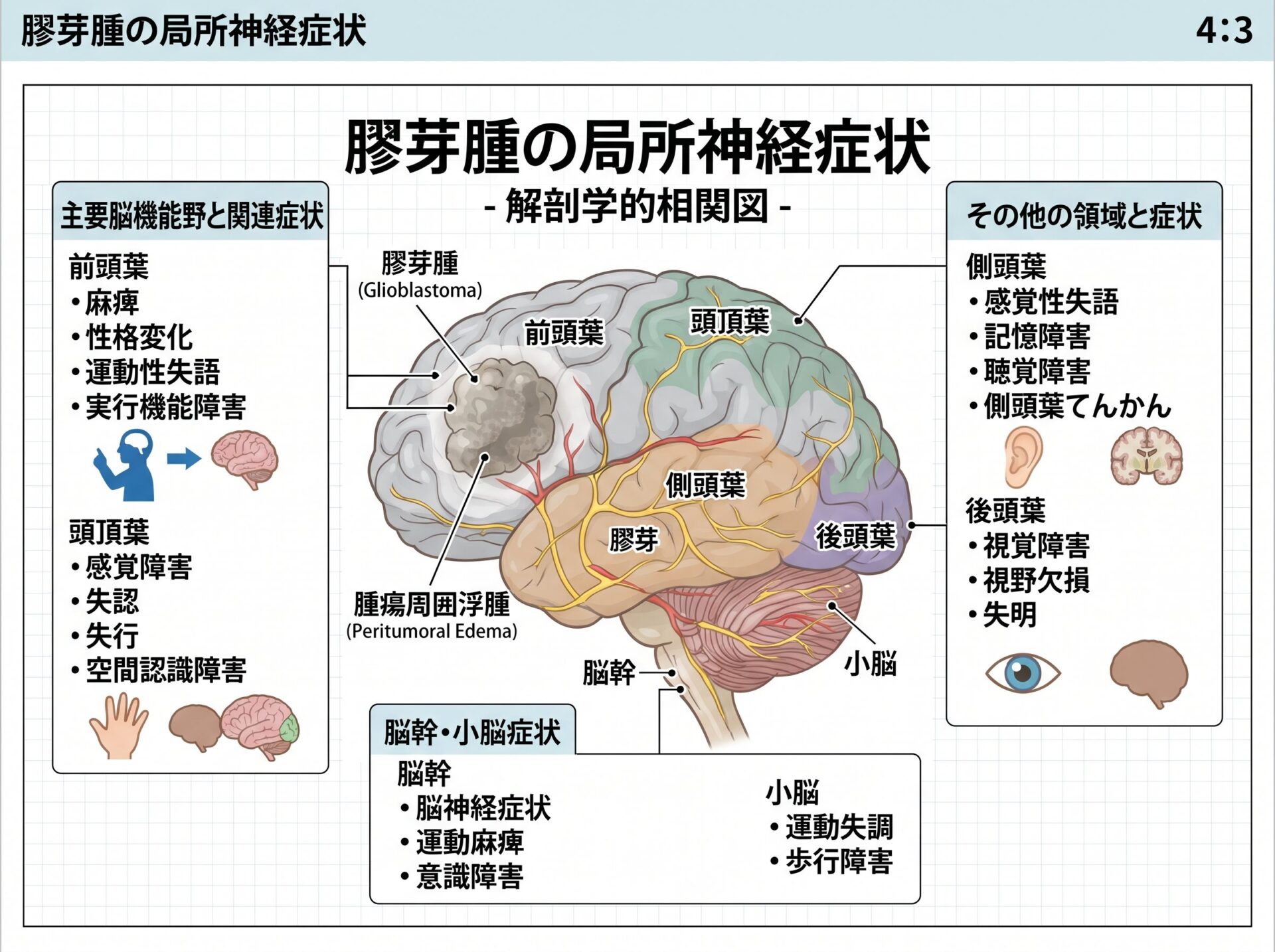 膠芽腫の局所神経症状