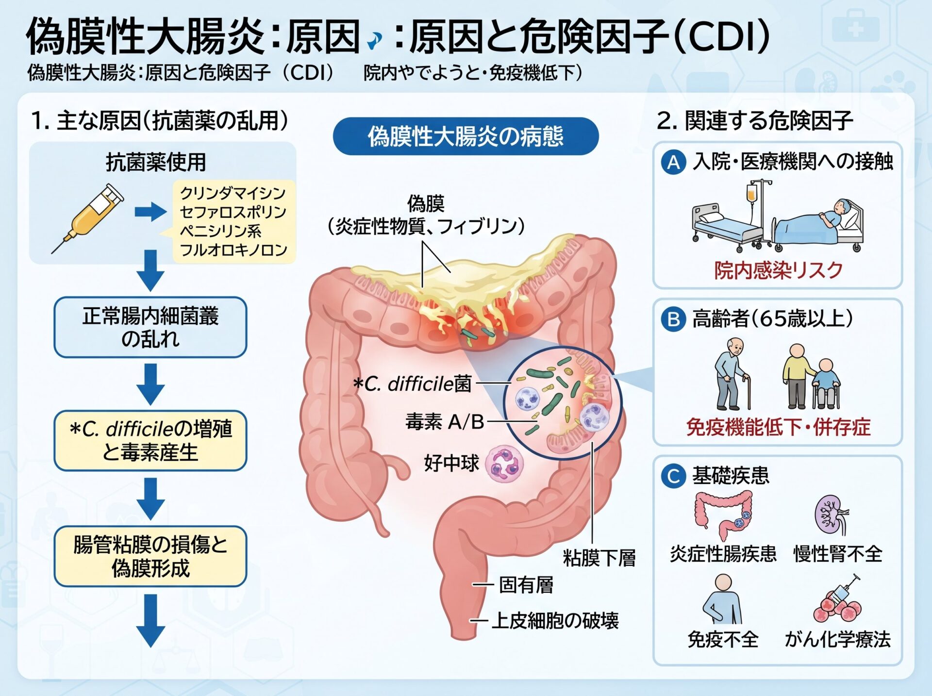 偽膜性大腸炎の原因と危険因子