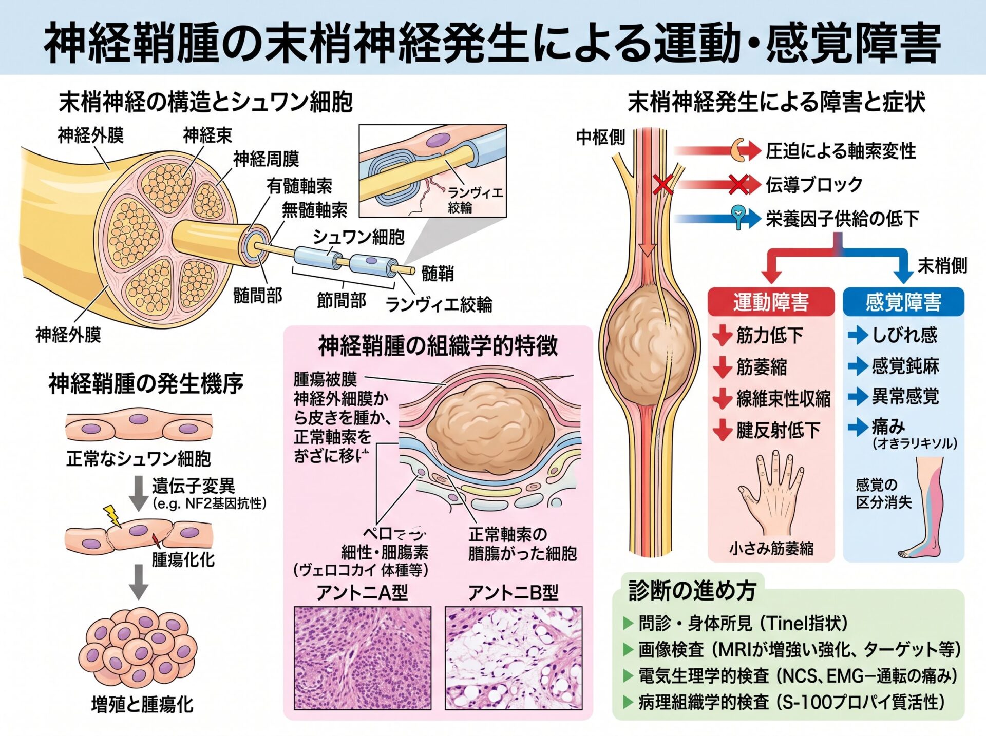 神経鞘腫の末梢神経発生による運動・感覚障害